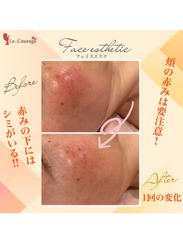 ル クラージュ(Le..Courage)/お肌の赤みは要注意です！