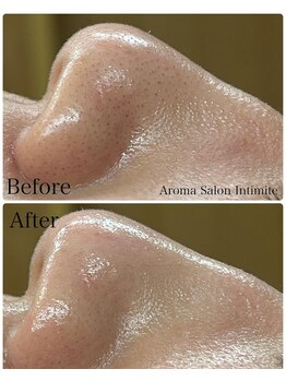 アンティミテ(Intimite)/毛穴洗浄1回の変化