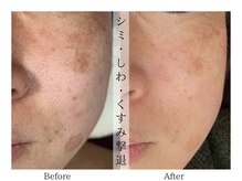 リララ(lelala)/ビフォーアフター☆