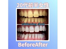 ホワイトニングショップ 西原店/20代前半女性☆BeforeAfter