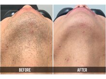 キビック(KIBIK)の雰囲気(男性人気no.1【ヒゲ脱毛】青ヒゲや朝のシェービングいらずの肌へ)