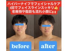 痩身ハイパーナイフメンズ【salon blue rose】新栄町/千種/痩身/ダイエット/脂肪燃焼/メンズフェイシャル/小顔/エステ