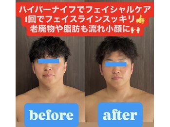 痩身ハイパーナイフメンズ【salon blue rose】新栄町/千種/痩身/ダイエット/脂肪燃焼/メンズフェイシャル/小顔/エステ
