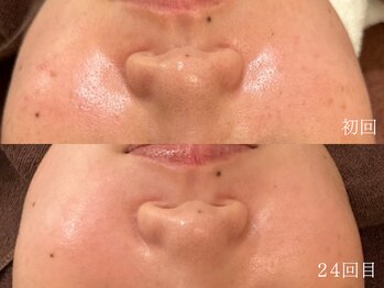 ウォーム(warm)/毛穴/毛穴洗浄/毛穴ケア/毛穴