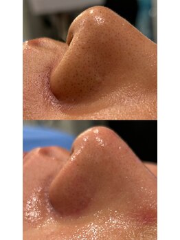プラチナムブロウ 新潟(PLATINUM BROW)の写真/【肌を整えて清潔感UP】毛穴・皮脂ケアで好印象なメンズフェイシャル