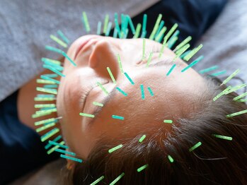 マヒナラボ 湘南(Mahina.lab)/美容鍼100本