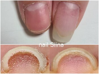 シーナ(Siina)の写真/「巻き爪、魚の目の痛みにお悩みのあなたへ」当店でスッキリ解決しましょう。状態に合わせてご案内。