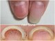シーナ(Siina)の写真/「巻き爪、魚の目の痛みにお悩みのあなたへ」当店でスッキリ解決しましょう。状態に合わせてご案内。