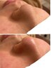 【毛穴・角質】毛穴洗浄フェイシャル