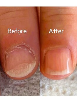 こんな剥離爪も☆