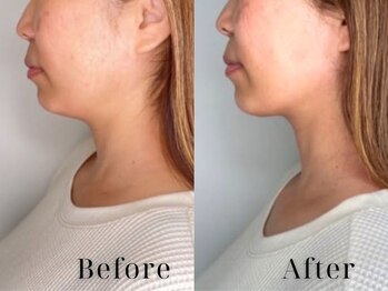 エープラス(A+)/フォト光フェイシャル