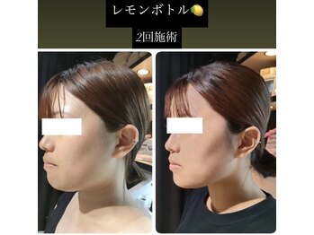 チャルム(CAL'ME)/レモンボトル・あごライン