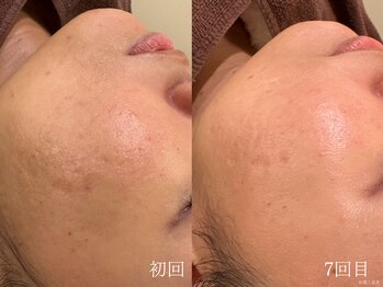 ウォーム(warm)/毛穴/毛穴洗浄/毛穴ケア/毛穴