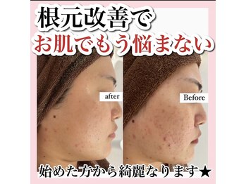 アルムダアクア 天王寺店(Aleumda AQUA)/大阪/天王寺/ハーブピーリング