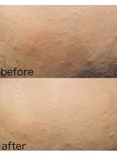 アトレ アンド ミューズ(Attrait×Muse)/ハイドラ×フェイシャルエステ