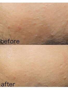 アトレ アンド ミューズ(Attrait×Muse)/ハイドラ×フェイシャルエステ