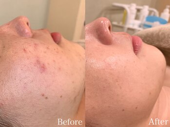 ビューティ ワンド ユズ(Beauty Wand YUZZ)/肌質改善ハーブピーリング 6回