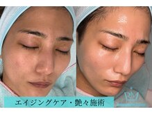 リメイクビューティークリニック(REMAKE BEAUTY CLINIC)/【症例】カカオジェントルピール