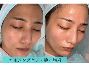 リメイクビューティークリニック(REMAKE BEAUTY CLINIC)/【症例】カカオジェントルピール