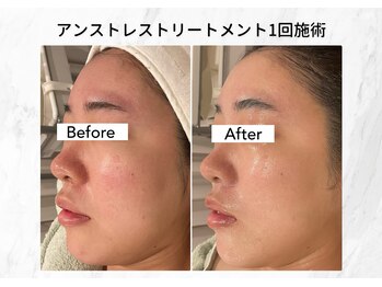 マーガレット(Marguerite)/CHRISTINA 乳酸菌ピーリング