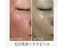 パーソナルデトックスサロン エヌ(N)/韓国式肌管理でツヤツヤ女優肌に