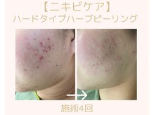 デジール(De'sir)の雰囲気（肌に合わせてハーブと棘を調合（ニキビ/くすみ/毛穴/凹凸肌））