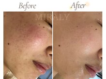 ミラリー(MIRALY)/赤み・肌荒れ跡ケア 3ヶ月(20代)