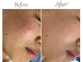 ミラリー(MIRALY)/赤み・肌荒れ跡ケア 3ヶ月(20代)