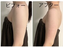 メディカルエステ ユウ(Yuu)の雰囲気（痩せにくい二の腕も一回でスッキリ！細くなります！）