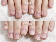 深爪矯正 爪悩み専門店 cocomo/(深爪/長さだし/フィルイン)