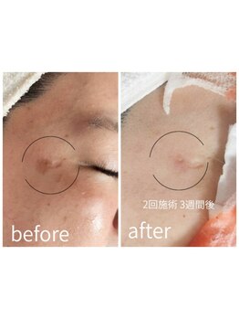 シミしわ改善！予防ケア