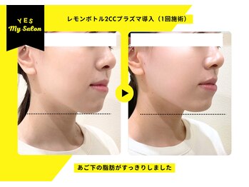 イエス マイサロン(yes My Salon)/レモンボトル施術例