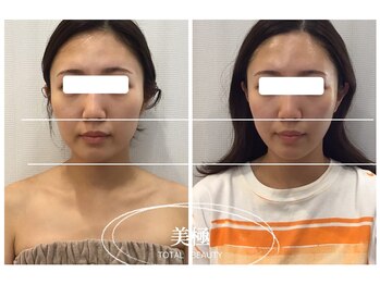 美極 トータルビューティー(美極 TOTAL BEAUTY)/恵比寿/小顔コルギ/エステ
