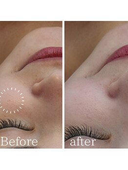 サロンド シェリー(Salon de Cherie)/剥けないハーブピーリング