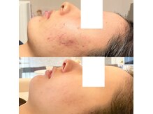 素肌キレイラボ(素肌キレイLab.)の雰囲気(こんなに結果が出る施術がサブスクならお得に通える?!)