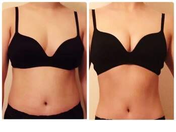 カナエルサロン 旭川(KANAERU SALON)/【バスト残しダイエット】症例☆