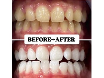 ホワイトニングサロン 宝塚/Before&After美白ホワイトニング