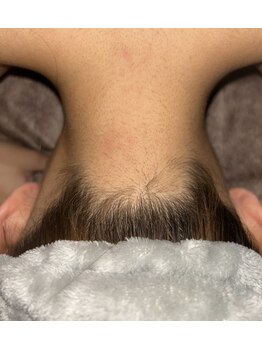 ベルフィオーレ(bel fiore)/10代女性 1ヶ月後 After