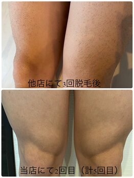 エイチ(H)/メンズ　足