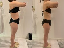 サロンリーナ 銀座店(SalonLena)/痩身(2ヶ月半)右側面