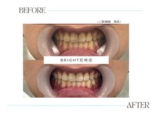 ホワイトニングサロンブライト 尼崎店(Whitening salon bright)/夏の間にホワイトニングを！