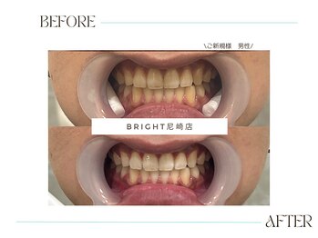 ホワイトニングサロンブライト 尼崎店(Whitening salon bright)/夏の間にホワイトニングを!