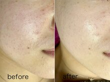 バタフライ 津田沼店(Butterfly)/Butterflyのハーブピーリング