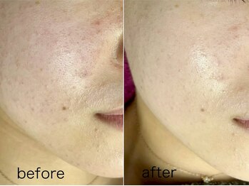 バタフライ 津田沼店(Butterfly)/Butterflyのハーブピーリング