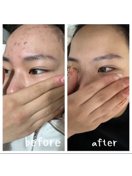 リアリ(Riali)の写真/地域最安×結果重視◎肌悩み別オーダーメイドハーブピーリング
あなた史上最高肌へ♪♪