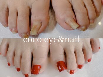 ココ(CoCo)/巻き爪