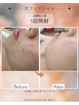 メイ(meiy)/美白/毛穴/赤ら顔/フェイシャル