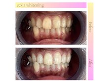 エクシアホワイトニング 武蔵小杉店/ビフォーアフター