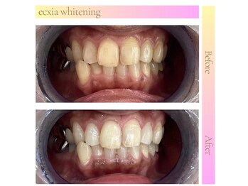 エクシアホワイトニング 武蔵小杉店/ビフォーアフター
