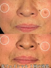 サロン ド マキ(Salon de Maki)/気軽にシミケアができる時代です